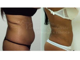 liposcultura prima dopo