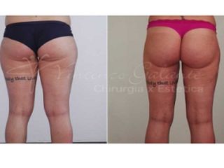 liposcultura prima dopo