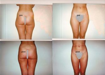 liposcultura prima dopo