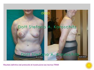 Ricostruzione mammaria