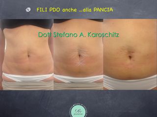 Fili PDO prima e dopo