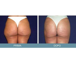 Liposcultura prima e dopo