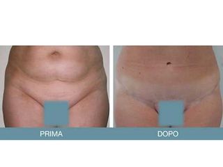 Addominoplastica prima e dopo