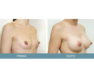 Mastoplastica additiva prima e dopo