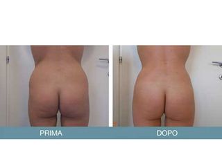 Liposcultura prima e dopo