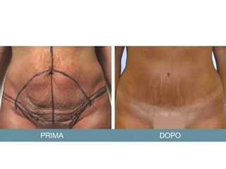 Addominoplastica prima e dopo