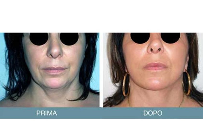 Lifting viso prima e dopo - 746253