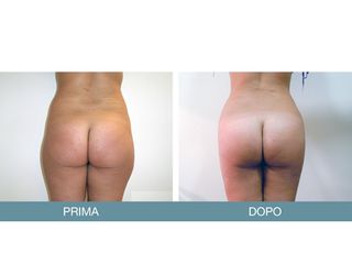 Liposcultura prima e dopo