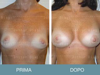 Mastoplastica additiva prima e dopo