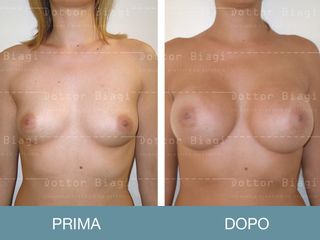 Mastoplastica additiva prima e dopo