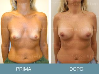 Mastoplastica additiva prima e dopo
