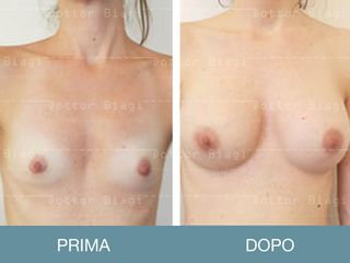 Mastoplastica additiva prima e dopo