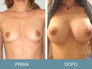 Mastoplastica additiva prima e dopo
