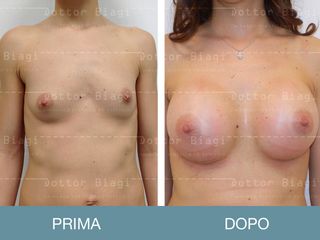 Mastoplastica additiva prima e dopo
