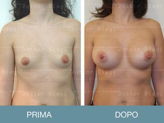 Mastoplastica additiva prima e dopo