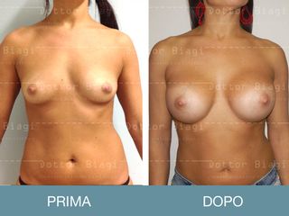 Mastoplastica additiva prima e dopo