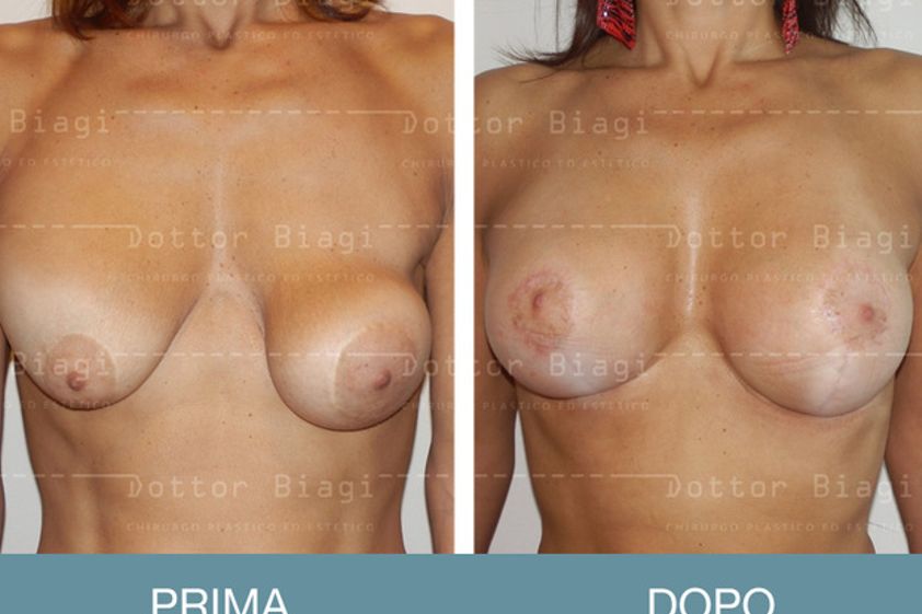 Sostituzione protesi mammarie prima e dopo - 752717