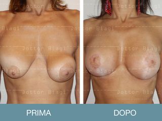 Mastoplastica correttiva prima e dopo