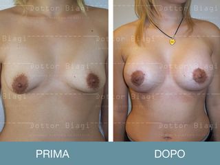 Mastoplastica additiva - Dott. Cristiano Biagi