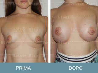 Mastoplastica additiva prima e dopo