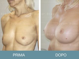 Mastoplastica additiva prima e dopo