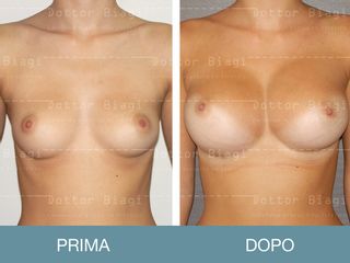 Mastoplastica additiva prima e dopo
