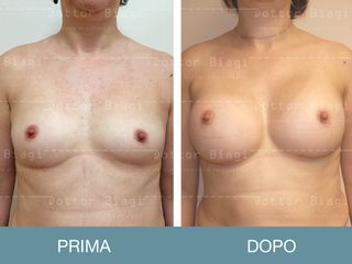 Mastoplastica additiva prima e dopo