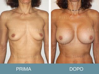 Mastoplastica additiva prima e dopo