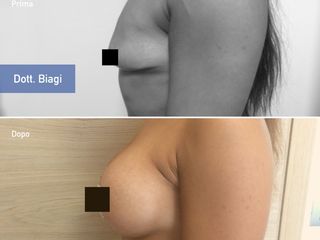 Mastopessi Additiva prima e dopo