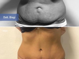 Addominoplastica pre e post