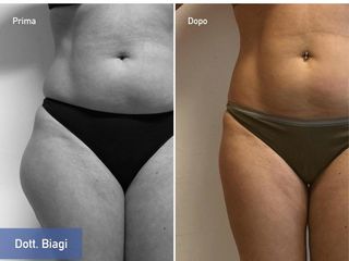 liposuzione fianchi prima e dopo