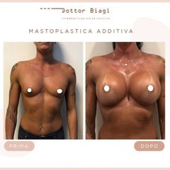 Mastoplastica additiva - Dott. Cristiano Biagi