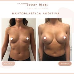 Mastoplastica additiva - Dott. Cristiano Biagi