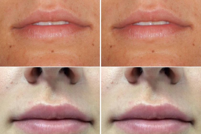 Filler labbra prima e dopo - 789263