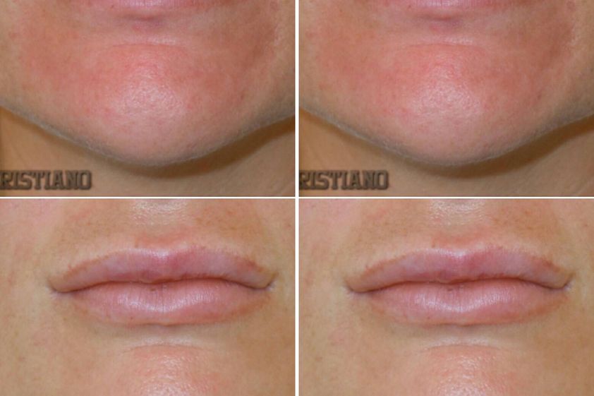 Lipofilling prima e dopo - 789266