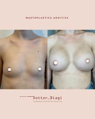 Mastoplastica additiva - Dott. Cristiano Biagi