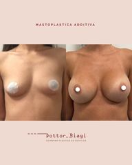 Mastoplastica additiva - Dott. Cristiano Biagi