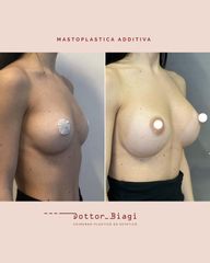 Mastoplastica additiva - Dott. Cristiano Biagi