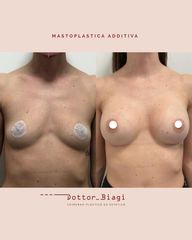 Mastoplastica additiva - Dott. Cristiano Biagi