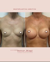 Mastoplastica additiva - Dott. Cristiano Biagi