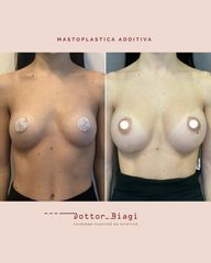 Mastoplastica additiva - Dott. Cristiano Biagi
