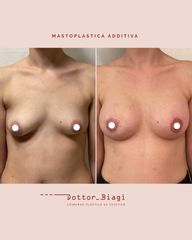 Mastoplastica additiva - Dott. Cristiano Biagi