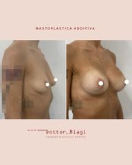 Mastoplastica additiva - Dott. Cristiano Biagi
