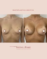 Mastoplastica additiva - Dott. Cristiano Biagi