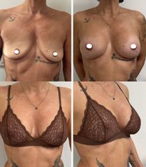 Dott. Cristiano Biagi Mastoplastica additiva