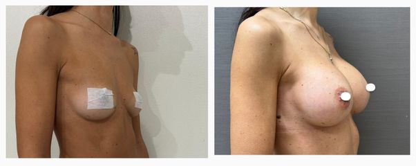 Dott. Cristiano Biagi Mastoplastica additiva
