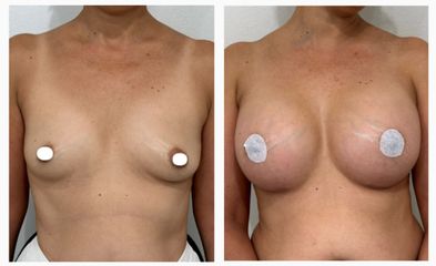 Dott. Cristiano Biagi Mastoplastica additiva