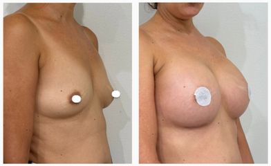 Dott. Cristiano Biagi Mastoplastica additiva