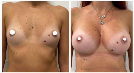 Dott. Cristiano Biagi Mastoplastica additiva