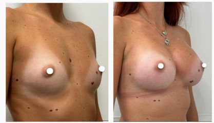 Dott. Cristiano Biagi Mastoplastica additiva